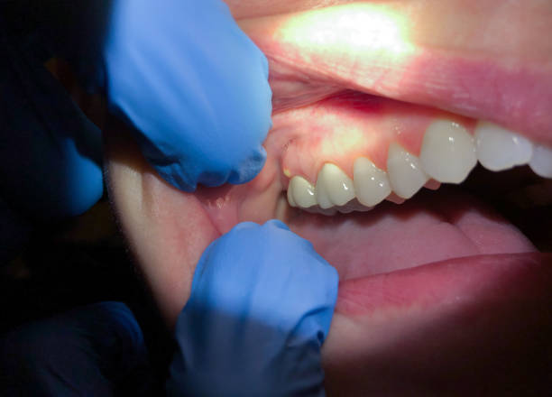 Best Chipped Tooth Repair Near Me  in Omro, WI